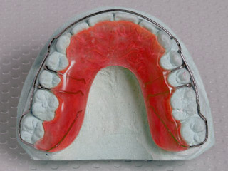 Herausnehmbare Zahnspange zum Halten der erreichten Zahnstellung - Kieferorthopädische Praxis Dr. Blens in Pulheim bei Köln