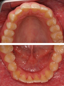 Intraorale Aufnahme der Zahnstellung