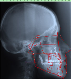 Fernröntgenaufnahme (FRS) eines kieferorthopädischen Patienten