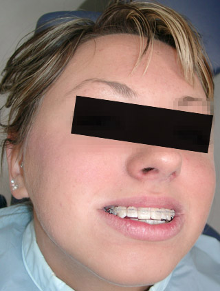 Kieferorthopädische Brackets aus Saphir (feste Zahnklammer) bei einer Patientin der Praxis Dr. Blens in Pulheim bei Köln