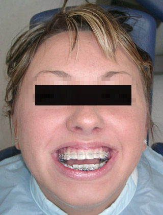 Feste Zahnspange mit Keramikbrackets bei einer kieferorthopädischen Patientin in der Praxis Dr. Blens in Pulheim