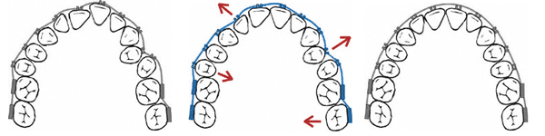 Zahnbewegung mit Hilfe einer festsitzenden Zahnspange in der Kieferorthopädie