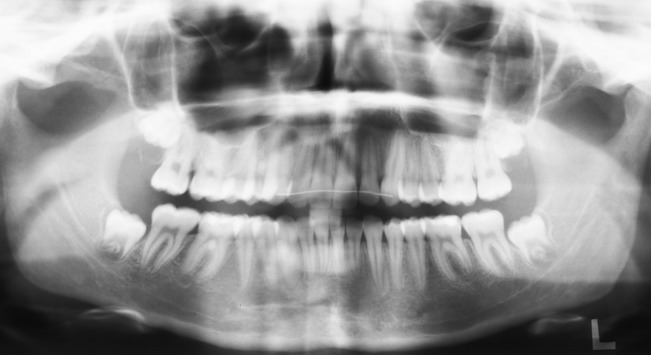 Orthopantomogramm (OPG) der Zähne zur kieferorthopädischen Planung