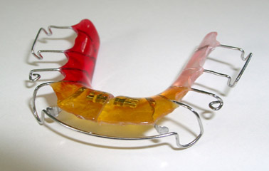 Herausnehmbare Zahnklammer für den Unterkiefer - Praxis für Kieferorthopädie Dr. Torsten Blens in Pulheim bei Köln