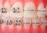 Metallbrackets und Saphirbrackets auf den Zähnen - Kieferorthopädische Praxis Dr. Blens in Pulheim